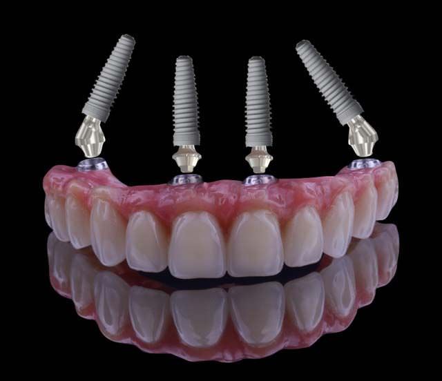 implantacia2