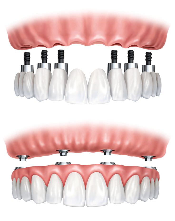 implantacia1
